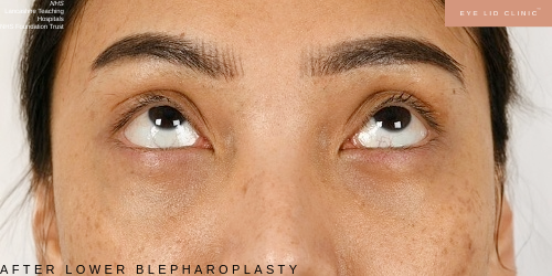 AFTER LOWER BLEPHAROPLASTY EYE BAG REMOVAL