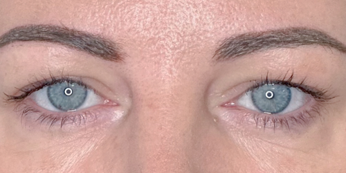 Before upper blepharoplasty. Dermatochalasis. Hooding