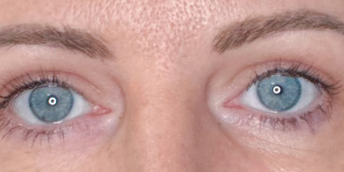 After upper blepharoplasty. Dermatochalasis. Eyelid lift