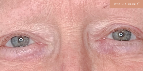 After ptosis surgery. Blepharoptosis repair. Droopy eyelid surgery