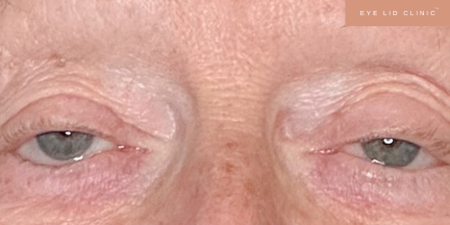 Ptosis. Blepharoptosis. Droopy Eyelid
