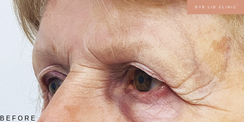 Before brow lift
