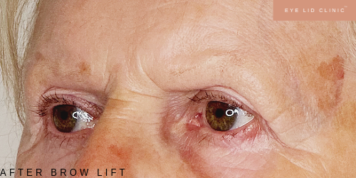 After brow lift