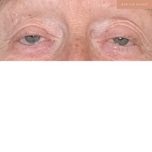 Ptosis