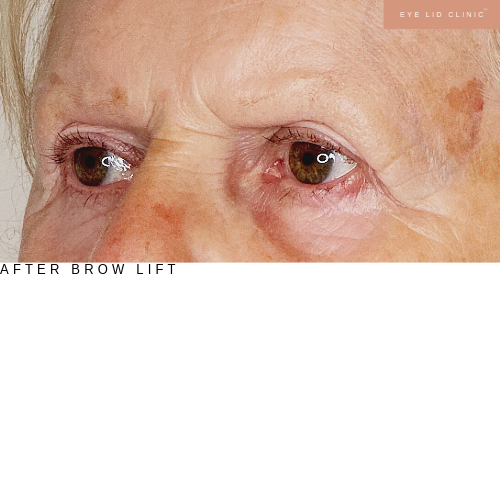 After brow lift